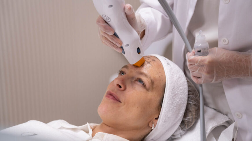 A woman getting Thermage treatment