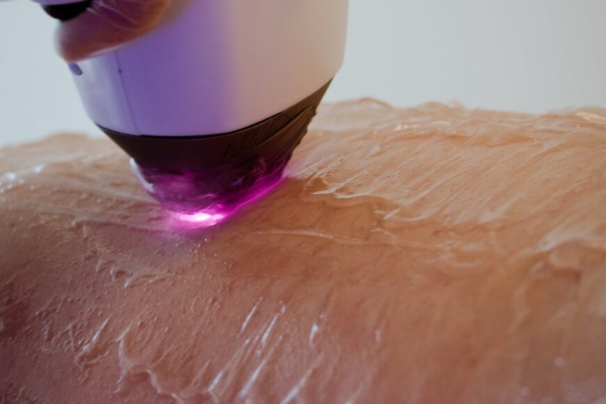 Laser hair removal