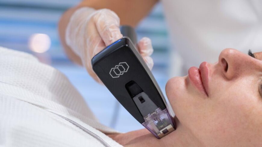 A woman getting her acne scars removed